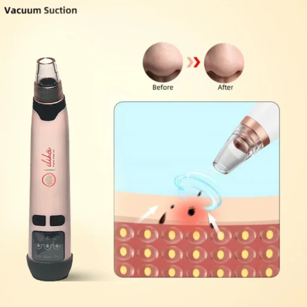 Blackhead Remover